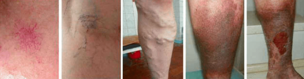 Fáze křečových žil na nohou